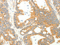 The image on the left is immunohistochemistry of paraffin-embedded Human colon cancer tissue using CSB-PA996514(AGRP Antibody) at dilution 1/20, on the right is treated with synthetic peptide. (Original magnification: ×200)