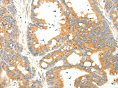 The image on the left is immunohistochemistry of paraffin-embedded Human colon cancer tissue using CSB-PA996514(AGRP Antibody) at dilution 1/20, on the right is treated with synthetic peptide. (Original magnification: ×200)