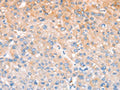 The image on the left is immunohistochemistry of paraffin-embedded Human liver cancer tissue using CSB-PA996565(CXCR4 Antibody) at dilution 1/40, on the right is treated with fusion protein. (Original magnification: ×200)