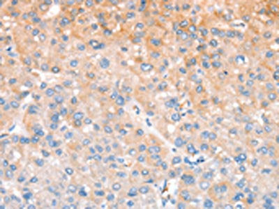 The image on the left is immunohistochemistry of paraffin-embedded Human liver cancer tissue using CSB-PA996565(CXCR4 Antibody) at dilution 1/40, on the right is treated with fusion protein. (Original magnification: ×200)