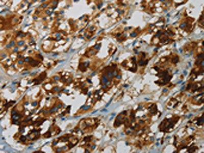 The image on the left is immunohistochemistry of paraffin-embedded Human colon cancer tissue using CSB-PA996906(FBXO32 Antibody) at dilution 1/25, on the right is treated with fusion protein. (Original magnification: ×200)