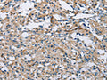 The image on the left is immunohistochemistry of paraffin-embedded Human thyroid cancer tissue using CSB-PA997274(PTK6 Antibody) at dilution 1/30, on the right is treated with fusion protein. (Original magnification: ×200)