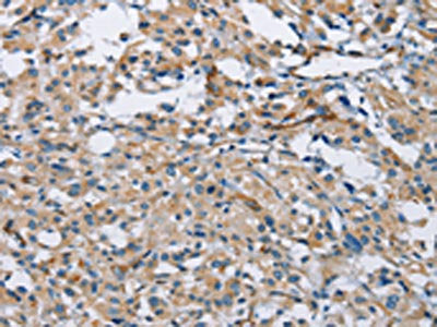 The image on the left is immunohistochemistry of paraffin-embedded Human thyroid cancer tissue using CSB-PA997274(PTK6 Antibody) at dilution 1/30, on the right is treated with fusion protein. (Original magnification: ×200)