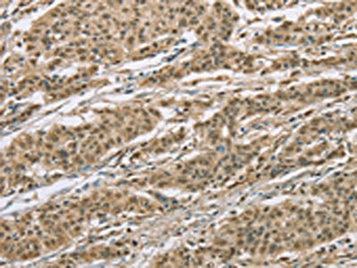 The image on the left is immunohistochemistry of paraffin-embedded Human gastic cancer tissue using CSB-PA997561(ELAC2 Antibody) at dilution 1/30, on the right is treated with fusion protein. (Original magnification: ×200)