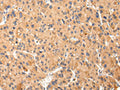 The image on the left is immunohistochemistry of paraffin-embedded Human liver cancer tissue using CSB-PA997657(ABCC1 Antibody) at dilution 1/25, on the right is treated with synthetic peptide. (Original magnification: X200)