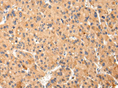 The image on the left is immunohistochemistry of paraffin-embedded Human liver cancer tissue using CSB-PA997657(ABCC1 Antibody) at dilution 1/25, on the right is treated with synthetic peptide. (Original magnification: X200)