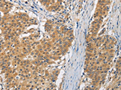 The image is immunohistochemistry of paraffin-embedded Human gastic cancer tissue using CSB-PA997710(FASTK Antibody) at dilution 1/30. (Original magnification: ×200)