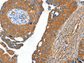 The image on the left is immunohistochemistry of paraffin-embedded Human cervical cancer tissue using CSB-PA998335(ACOT11 Antibody) at dilution 1/40, on the right is treated with fusion protein. (Original magnification: ×200)
