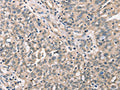 The image on the left is immunohistochemistry of paraffin-embedded Human ovarian cancer tissue using CSB-PA998940(CDK12 Antibody) at dilution 1/30, on the right is treated with synthetic peptide. (Original magnification: ×200)
