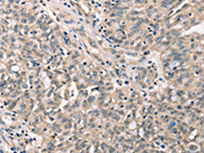 The image on the left is immunohistochemistry of paraffin-embedded Human ovarian cancer tissue using CSB-PA998940(CDK12 Antibody) at dilution 1/30, on the right is treated with synthetic peptide. (Original magnification: ×200)