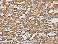The image on the left is immunohistochemistry of paraffin-embedded Human thyroid cancer tissue using CSB-PA999330(ARHGAP25 Antibody) at dilution 1/40, on the right is treated with fusion protein. (Original magnification: ×200)