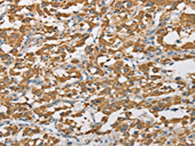 The image on the left is immunohistochemistry of paraffin-embedded Human thyroid cancer tissue using CSB-PA999330(ARHGAP25 Antibody) at dilution 1/40, on the right is treated with fusion protein. (Original magnification: ×200)
