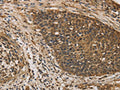 The image on the left is immunohistochemistry of paraffin-embedded Human cervical cancer tissue using CSB-PA999451(DACH1 Antibody) at dilution 1/50, on the right is treated with fusion protein. (Original magnification: ×200)