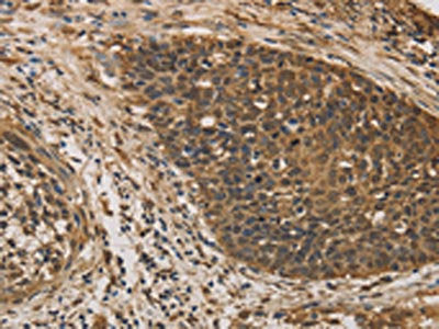 The image on the left is immunohistochemistry of paraffin-embedded Human cervical cancer tissue using CSB-PA999451(DACH1 Antibody) at dilution 1/50, on the right is treated with fusion protein. (Original magnification: ×200)