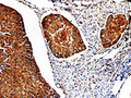 The image on the left is immunohistochemistry of paraffin-embedded Human cervical cancer tissue using CSB-PA999488(PKM Antibody) at dilution 1/50, on the right is treated with fusion protein. (Original magnification: ×200)