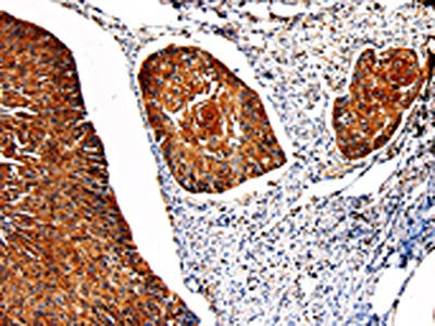 The image on the left is immunohistochemistry of paraffin-embedded Human cervical cancer tissue using CSB-PA999488(PKM Antibody) at dilution 1/50, on the right is treated with fusion protein. (Original magnification: ×200)