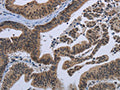 The image on the left is immunohistochemistry of paraffin-embedded Human gastic cancer tissue using CSB-PA999654(EPHA10 Antibody) at dilution 1/20, on the right is treated with fusion protein. (Original magnification: ×200)