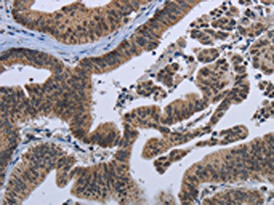 The image on the left is immunohistochemistry of paraffin-embedded Human gastic cancer tissue using CSB-PA999654(EPHA10 Antibody) at dilution 1/20, on the right is treated with fusion protein. (Original magnification: ×200)