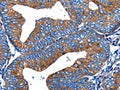 The image on the left is immunohistochemistry of paraffin-embedded Human cervical cancer tissue using CSB-PA999740(MERTK Antibody) at dilution 1/13, on the right is treated with fusion protein. (Original magnification: ×200)