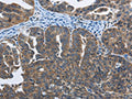 The image on the left is immunohistochemistry of paraffin-embedded Human ovarian cancer tissue using CSB-PA999782(SYT3 Antibody) at dilution 1/40, on the right is treated with fusion protein. (Original magnification: ×200)