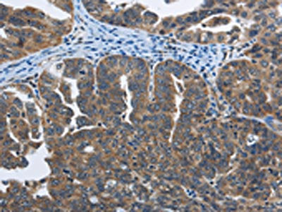 The image on the left is immunohistochemistry of paraffin-embedded Human ovarian cancer tissue using CSB-PA999782(SYT3 Antibody) at dilution 1/40, on the right is treated with fusion protein. (Original magnification: ×200)