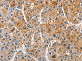 The image on the left is immunohistochemistry of paraffin-embedded Human liver cancer tissue using CSB-PA999801(PRKCE Antibody) at dilution 1/50, on the right is treated with fusion protein. (Original magnification: ×200)