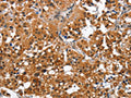 The image on the left is immunohistochemistry of paraffin-embedded Human thyroid cancer tissue using CSB-PA999927(CAMK1D Antibody) at dilution 1/50, on the right is treated with fusion protein. (Original magnification: ×200)
