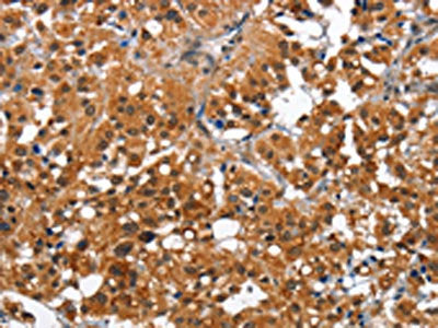 The image on the left is immunohistochemistry of paraffin-embedded Human thyroid cancer tissue using CSB-PA999927(CAMK1D Antibody) at dilution 1/50, on the right is treated with fusion protein. (Original magnification: ×200)