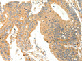 The image on the left is immunohistochemistry of paraffin-embedded Human colon cancer tissue using CSB-PA999934(AGRP Antibody) at dilution 1/20, on the right is treated with synthetic peptide. (Original magnification: ×200)