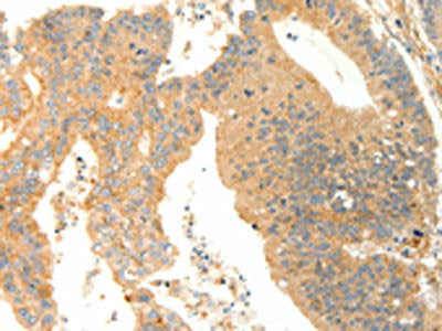 The image on the left is immunohistochemistry of paraffin-embedded Human colon cancer tissue using CSB-PA999934(AGRP Antibody) at dilution 1/20, on the right is treated with synthetic peptide. (Original magnification: ×200)