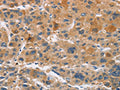 The image on the left is immunohistochemistry of paraffin-embedded Human liver cancer tissue using CSB-PA999937(CYP4A11 Antibody) at dilution 1/30, on the right is treated with fusion protein. (Original magnification: ×200)