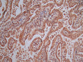 IHC image of CSB-RA001492MA1HU diluted at 1:50 and staining in paraffin-embedded human endometrial cancer performed on a Leica BondTM system. After dewaxing and hydration, antigen retrieval was mediated by high pressure in a citrate buffer (pH 6.0) . Section was blocked with 10% normal goat serum 30min at RT. Then primary antibody (1% BSA)  was incubated at 4°C overnight. The primary is detected by a Goat anti-Mouse IgG labeled by HRP and visualized using 0.05% DAB.