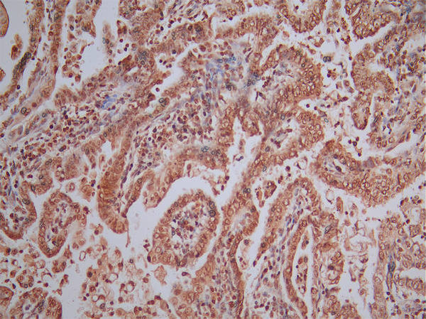 IHC image of CSB-RA001492MA1HU diluted at 1:50 and staining in paraffin-embedded human endometrial cancer performed on a Leica BondTM system. After dewaxing and hydration, antigen retrieval was mediated by high pressure in a citrate buffer (pH 6.0) . Section was blocked with 10% normal goat serum 30min at RT. Then primary antibody (1% BSA)  was incubated at 4°C overnight. The primary is detected by a Goat anti-Mouse IgG labeled by HRP and visualized using 0.05% DAB.