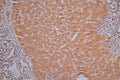 IHC image of CSB-RA001836MA1HU diluted at 1:30 and staining in paraffin-embedded human liver cancer performed on a Leica BondTM system. After dewaxing and hydration,  antigen retrieval was mediated by high pressure in a citrate buffer (pH 6.0) . Section was blocked with 10% normal goat serum 30min at RT. Then primary antibody (1% BSA) was incubated at 4°C overnight. The primary is detected by a Goat anti-Mouse IgG labeled by HRP and visualized using 0.05% DAB.