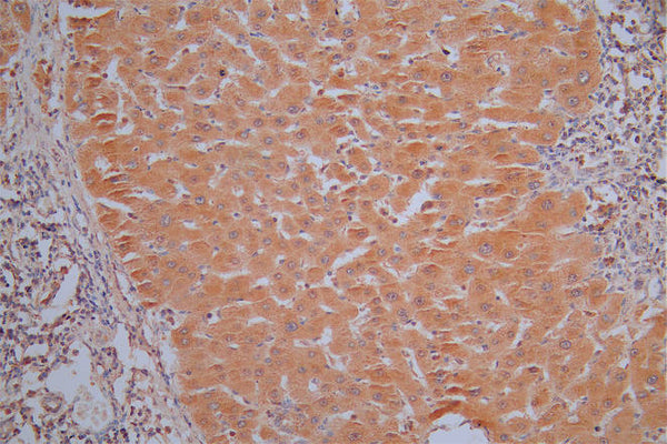 IHC image of CSB-RA001836MA1HU diluted at 1:30 and staining in paraffin-embedded human liver cancer performed on a Leica BondTM system. After dewaxing and hydration,  antigen retrieval was mediated by high pressure in a citrate buffer (pH 6.0) . Section was blocked with 10% normal goat serum 30min at RT. Then primary antibody (1% BSA) was incubated at 4°C overnight. The primary is detected by a Goat anti-Mouse IgG labeled by HRP and visualized using 0.05% DAB.