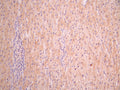 IHC image of CSB-RA002873MA2HU diluted at 1:50 and staining in paraffin-embedded human liver cancer performed on a Leica BondTM system. After dewaxing and hydration, antigen retrieval was mediated by high pressure in a citrate buffer (pH 6.0). Section was blocked with 10% normal goat serum 30min at RT. Then primary antibody (1% BSA) was incubated at 4°C overnight. The primary is detected by a Anti-Human lgG, Fcy Fragment Specific labeled by HRP and visualized using 0.05% DAB.
