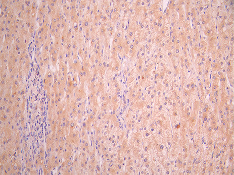 IHC image of CSB-RA002873MA2HU diluted at 1:50 and staining in paraffin-embedded human liver cancer performed on a Leica BondTM system. After dewaxing and hydration, antigen retrieval was mediated by high pressure in a citrate buffer (pH 6.0). Section was blocked with 10% normal goat serum 30min at RT. Then primary antibody (1% BSA) was incubated at 4°C overnight. The primary is detected by a Anti-Human lgG, Fcy Fragment Specific labeled by HRP and visualized using 0.05% DAB.