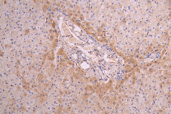 IHC image of CSB-RA004879MA1HU diluted at 1：100 and staining in paraffin-embedded human liver tissue performed on a Leica BondTM system. After dewaxing and hydration, antigen retrieval was mediated by high pressure in a citrate buffer (pH 6.0) . Section was blocked with 10% normal goat serum 30min at RT. Then primary antibody (1% BSA) was incubated at 4°C overnight. The primary is detected by a Goat anti-human polymer IgG labeled by HRP and visualized using 0.05% DAB.