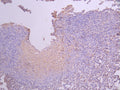IHC image of CSB-RA004929MA3HU diluted at 1：50 and staining in paraffin-embedded human prostate cancer performed on a Leica BondTM system. After dewaxing and hydration, antigen retrieval was mediated by high pressure in a citrate buffer (pH 6.0) . Section was blocked with 10% normal goat serum 30min at RT. Then primary antibody (1% BSA) was incubated at 4°C overnight. The primary is detected by a Anti-Human lgG, Fcy Fragment Specific labeled by HRP and visualized using 0.05% DAB.