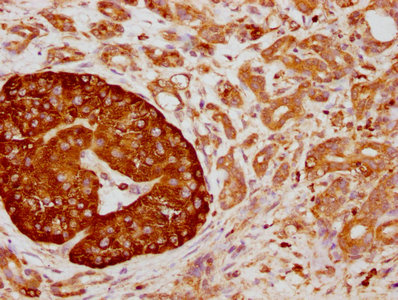 IHC image of CSB-RA004950A0HU diluted at 1:155 and staining in paraffin-embedded human pancreatic cancer performed on a Leica BondTM system. After dewaxing and hydration, antigen retrieval was mediated by high pressure in a citrate buffer (pH 6.0) . Section was blocked with 10% normal goat serum 30min at RT. Then primary antibody (1% BSA) was incubated at 4℃ overnight. The primary is detected by a biotinylated secondary antibody and visualized using an HRP conjugated SP system.