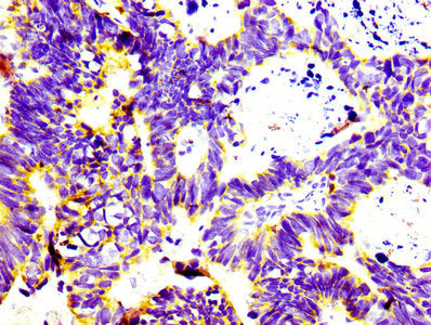 IHC image of CSB-RA004956A0HU diluted at 1:100 and staining in paraffin-embedded human ovarian cancer performed on a Leica BondTM system. After dewaxing and hydration, antigen retrieval was mediated by high pressure in a citrate buffer (pH 6.0) . Section was blocked with 10% normal goat serum 30min at RT. Then primary antibody (1% BSA) was incubated at 4&deg;C overnight. The primary is detected by a biotinylated secondary antibody and visualized using an HRP conjugated SP system.