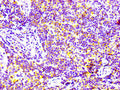 IHC image of CSB-RA004972A0HU diluted at 1:100 and staining in paraffin-embedded human lymph node tissue performed on a Leica BondTM system. After dewaxing and hydration, antigen retrieval was mediated by high pressure in a citrate buffer (pH 6.0) . Section was blocked with 10% normal goat serum 30min at RT. Then primary antibody (1% BSA) was incubated at 4℃ overnight. The primary is detected by a biotinylated secondary antibody and visualized using an HRP conjugated SP system.