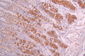 IHC image of CSB-RA005621MA1HU diluted at 1:50 and staining in paraffin-embedded human gastric cancer performed on a Leica BondTM system. After dewaxing and hydration, antigen retrieval was mediated by high pressure in a citrate buffer (pH 6.0) . Section was blocked with 10% normal goat serum 30min at RT. Then primary antibody (1% BSA) was incubated at 4°C overnight. The primary is detected by a Anti-Human lgG, Fcy Fragment Specific labeled by HRP and visualized using 0.05% DAB.