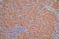 IHC image of CSB-RA006193MA1HU diluted at 1:30 and staining in paraffin-embedded human liver cancer performed on a Leica BondTM system. After dewaxing and hydration,  antigen retrieval was mediated by high pressure in a citrate buffer (pH 6.0) . Section was blocked with 10% normal goat serum 30min at RT. Then primary antibody (1% BSA) was incubated at 4°C overnight. The primary is detected by a Goat anti-Mouse IgG labeled by HRP and visualized using 0.05% DAB.