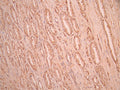 IHC image of CSB-RA006328MA1HU diluted at 1:50 and staining in paraffin-embedded human prostate cancer performed on a Leica BondTM system. After dewaxing and hydration, antigen retrieval was mediated by high pressure in a citrate buffer (pH 6.0). Section was blocked with 10% normal goat serum 30min at RT. Then primary antibody (1% BSA) was incubated at 4°C overnight. The primary is detected by a Anti-Human lgG, Fcy Fragment Specific labeled by HRP and visualized using 0.05% DAB.