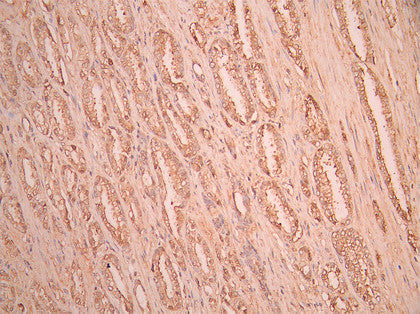 IHC image of CSB-RA006328MA1HU diluted at 1:50 and staining in paraffin-embedded human prostate cancer performed on a Leica BondTM system. After dewaxing and hydration, antigen retrieval was mediated by high pressure in a citrate buffer (pH 6.0). Section was blocked with 10% normal goat serum 30min at RT. Then primary antibody (1% BSA) was incubated at 4°C overnight. The primary is detected by a Anti-Human lgG, Fcy Fragment Specific labeled by HRP and visualized using 0.05% DAB.