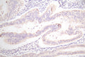 IHC image of CSB-RA007717MA1HU diluted at 1:100 and staining in paraffin-embedded human endometrial cancer performed on a Leica BondTM system. After dewaxing and hydration,  antigen retrieval was mediated by high pressure in a citrate buffer (pH 6.0) . Section was blocked with 10% normal goat serum 30min at RT. Then primary antibody (1% BSA) was incubated at 4°C overnight. The primary is detected by a Goat anti-Mouse IgG labeled by HRP and visualized using 0.05% DAB.