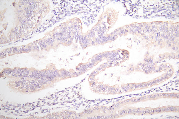 IHC image of CSB-RA007717MA1HU diluted at 1:100 and staining in paraffin-embedded human endometrial cancer performed on a Leica BondTM system. After dewaxing and hydration,  antigen retrieval was mediated by high pressure in a citrate buffer (pH 6.0) . Section was blocked with 10% normal goat serum 30min at RT. Then primary antibody (1% BSA) was incubated at 4°C overnight. The primary is detected by a Goat anti-Mouse IgG labeled by HRP and visualized using 0.05% DAB.