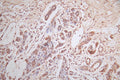 IHC image of CSB-RA007763MA2HU diluted at 1:600 and staining in paraffin-embedded human breast cancer performed on a Leica BondTM system. After dewaxing and hydration, antigen retrieval was mediated by high pressure in a citrate buffer (pH 6.0) . Section was blocked with 10% normal goat serum 30min at RT. Then primary antibody (1% BSA) was incubated at 4°C overnight. The primary is detected by a Goat anti-Mouse IgG labeled by HRP and visualized using 0.05% DAB.