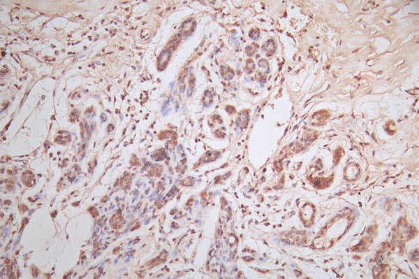 IHC image of CSB-RA007763MA2HU diluted at 1:600 and staining in paraffin-embedded human breast cancer performed on a Leica BondTM system. After dewaxing and hydration, antigen retrieval was mediated by high pressure in a citrate buffer (pH 6.0) . Section was blocked with 10% normal goat serum 30min at RT. Then primary antibody (1% BSA) was incubated at 4°C overnight. The primary is detected by a Goat anti-Mouse IgG labeled by HRP and visualized using 0.05% DAB.